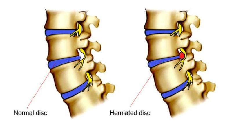 Lumbar Disc Bulge Treatment